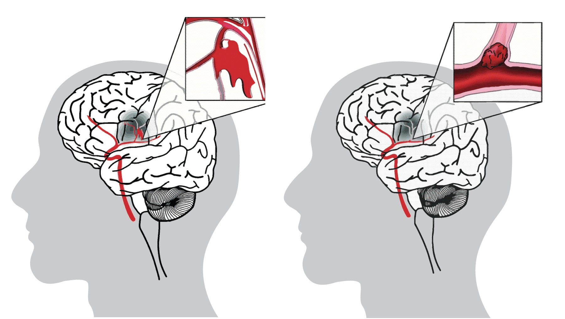 Two drawings of the brain with one showing a haemorrhagic stroke and the other showing an ischaemic stroke