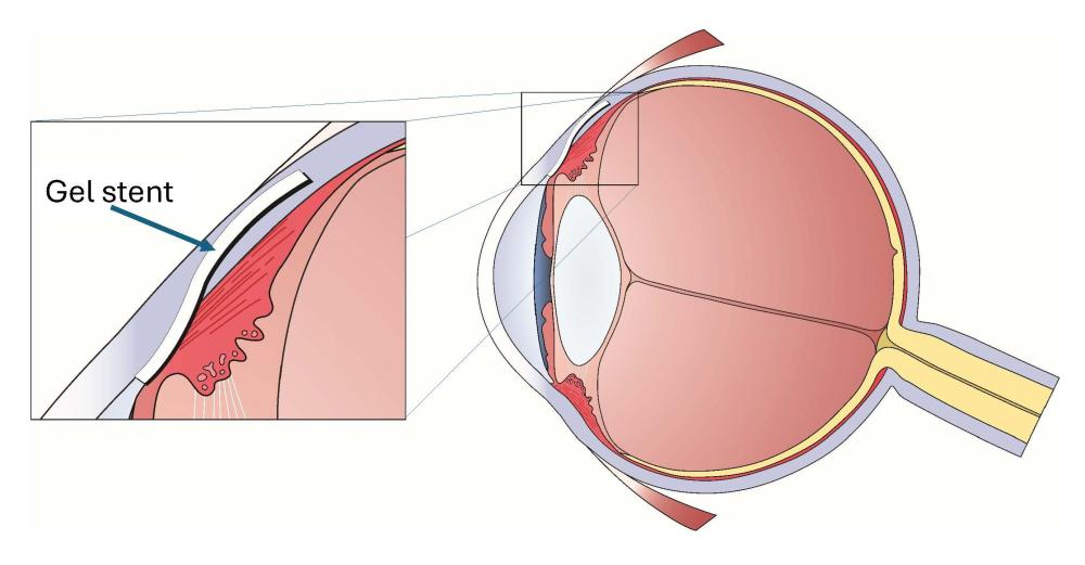 A diagram of an eye, showing the implant location of the gel stent