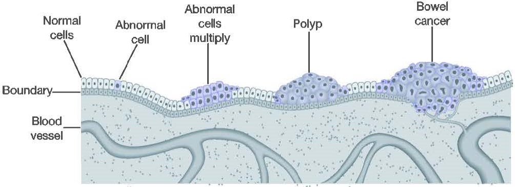 A diagram showing how bowel cancer usually develops.