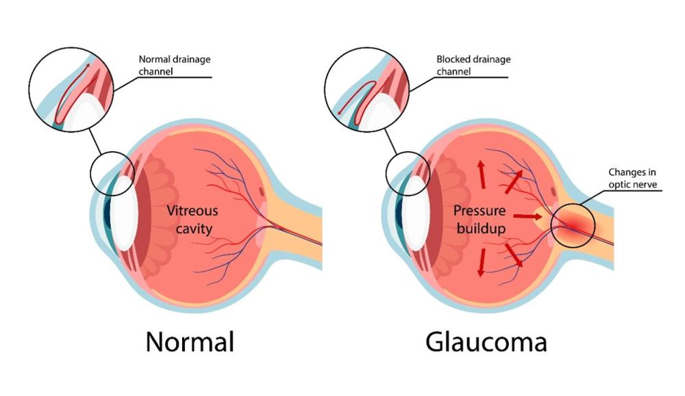 Two images: Left – fluid exits the eye through the normal drainage channel. Right – a blocked drainage channel leads to incr eased IOP and glaucoma