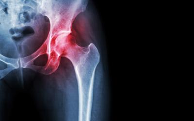 X-ray of inflamed hip joint